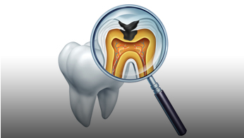 Root Canal Treatment